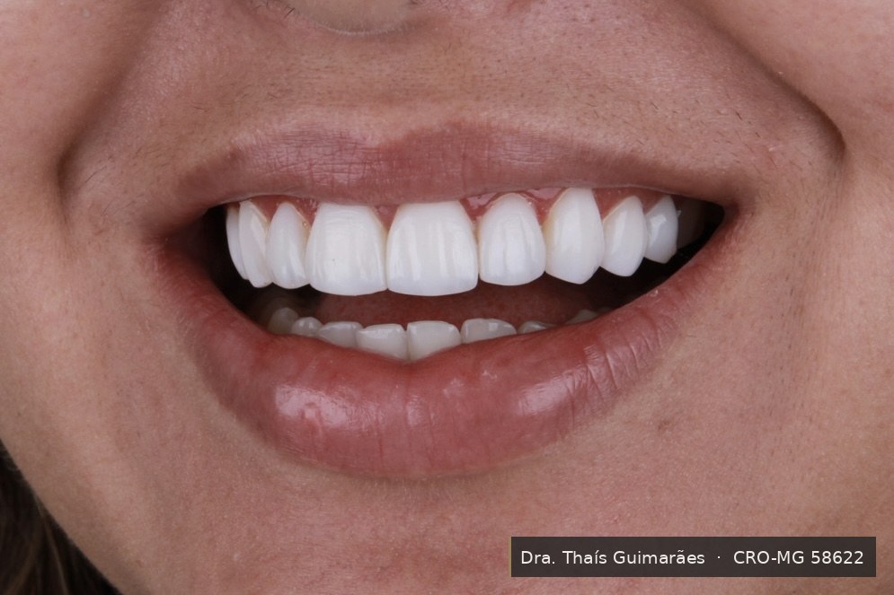 Sorriso finalizado após lentes de contato dental — paciente da Dra. Thaís Guimarães