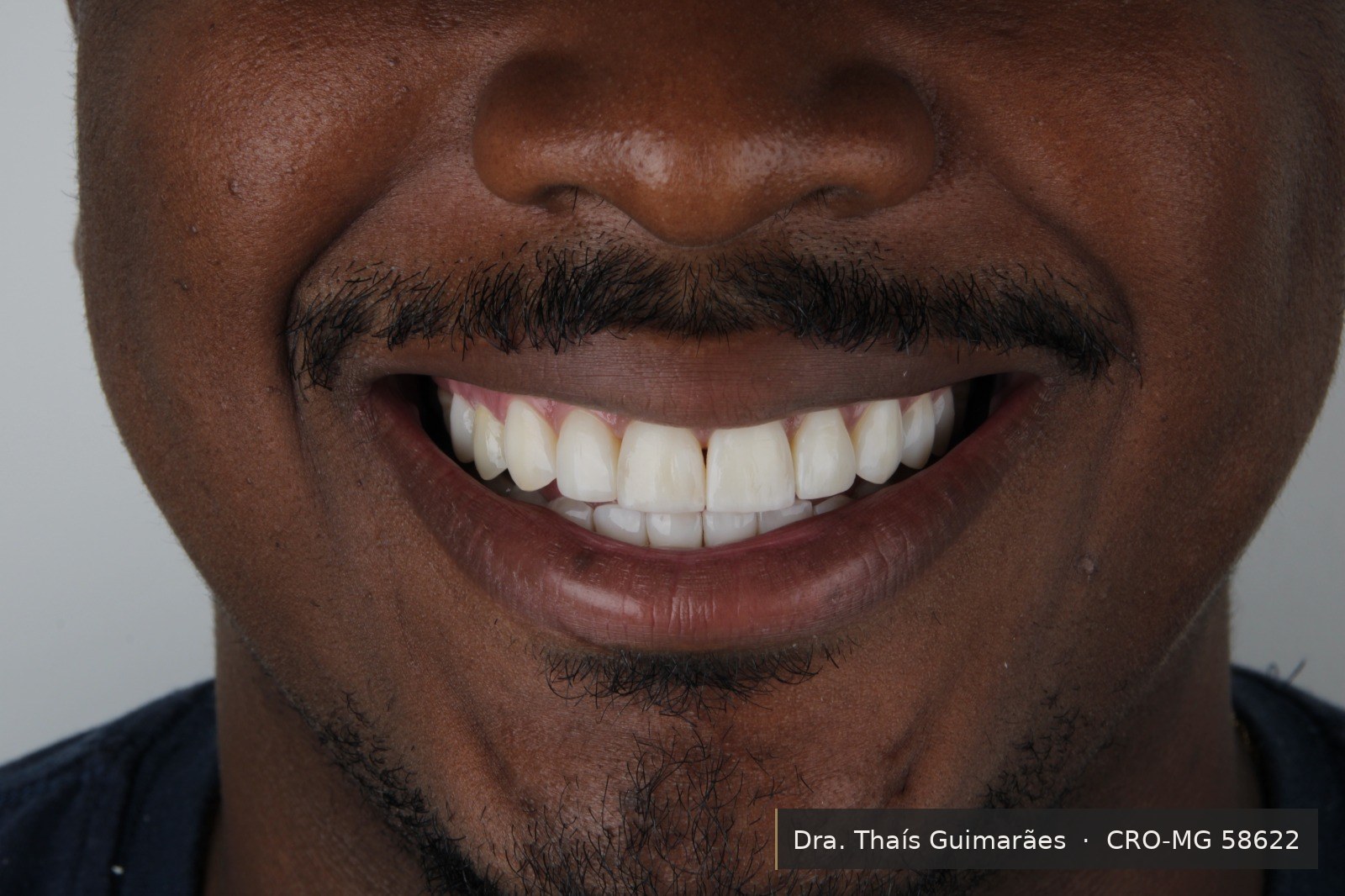 Sorriso finalizado após lentes de contato dental — paciente da Dra. Thaís Guimarães