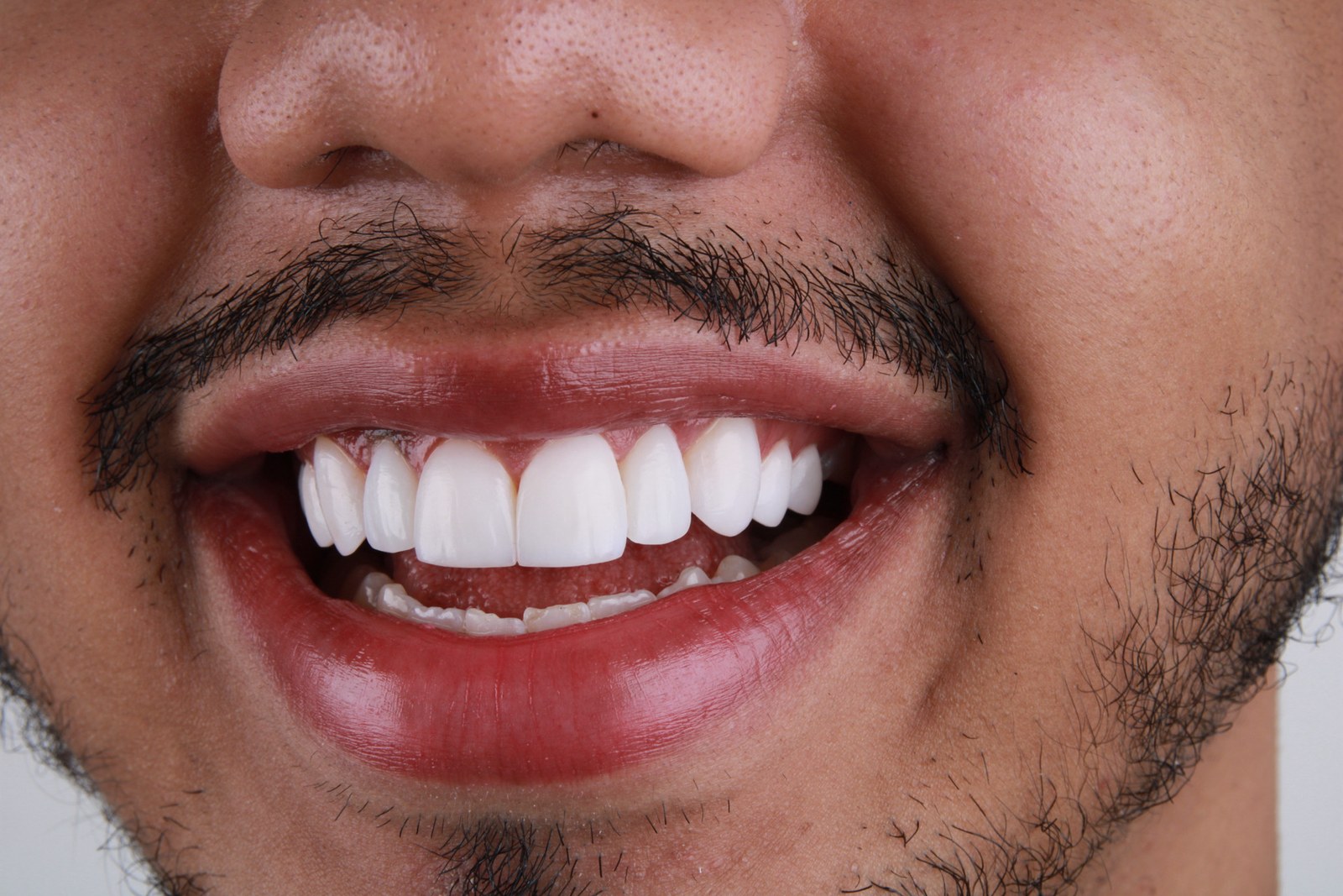 Sorriso após lentes de contato dental — dentes claros, alinhados e proporcionais
