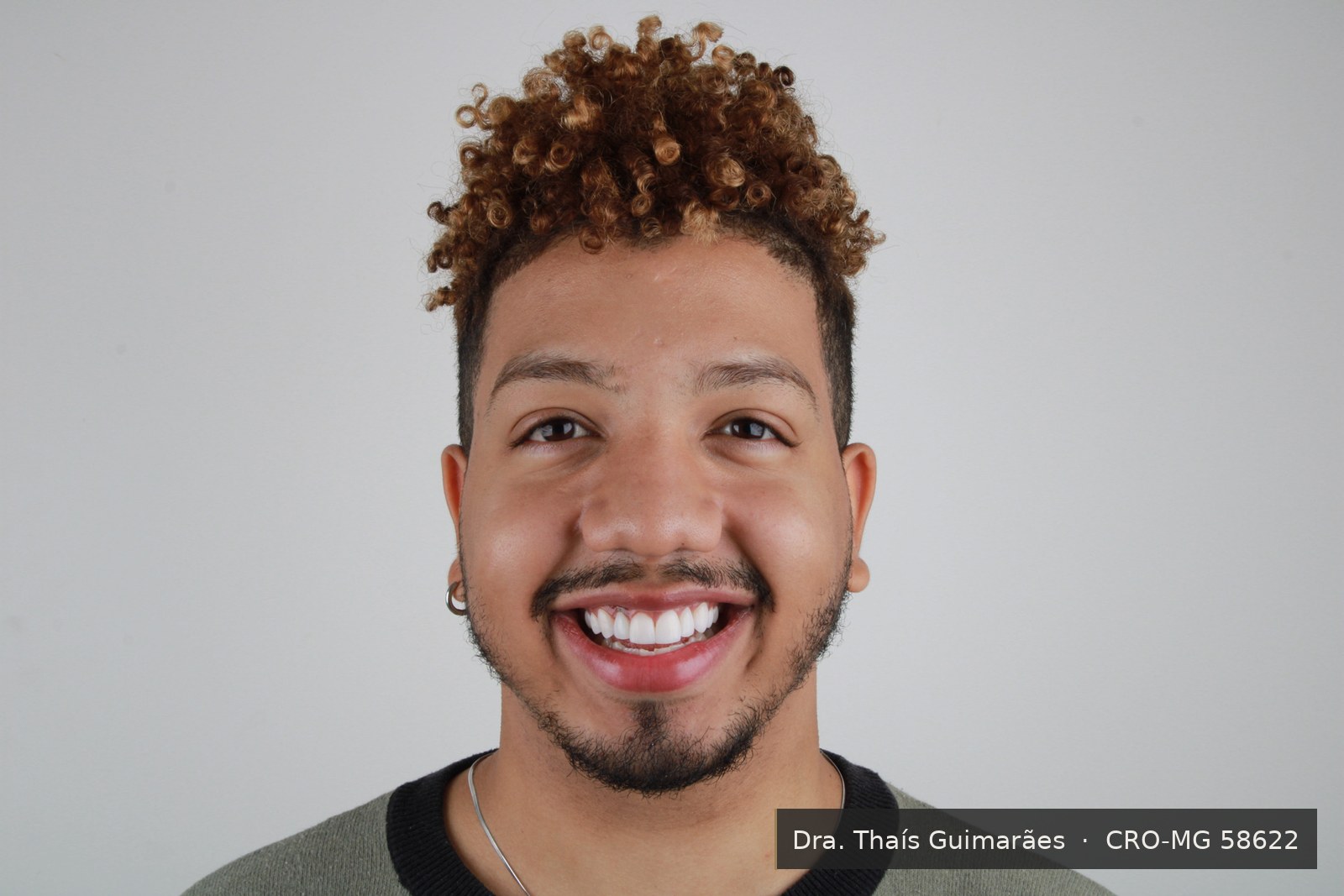 Sorriso finalizado após lentes de contato dental — paciente da Dra. Thaís Guimarães