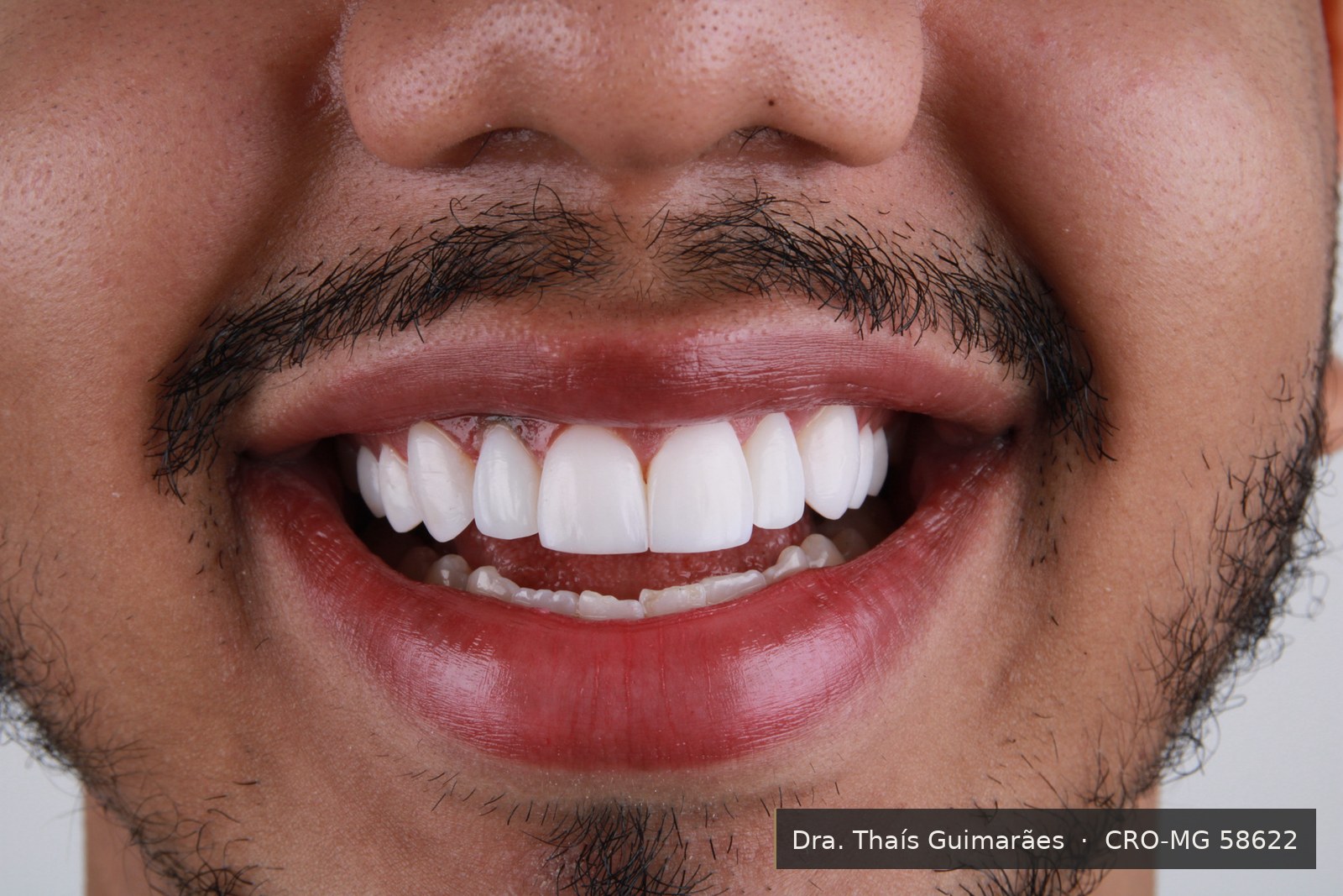 Sorriso finalizado após lentes de contato dental — paciente da Dra. Thaís Guimarães