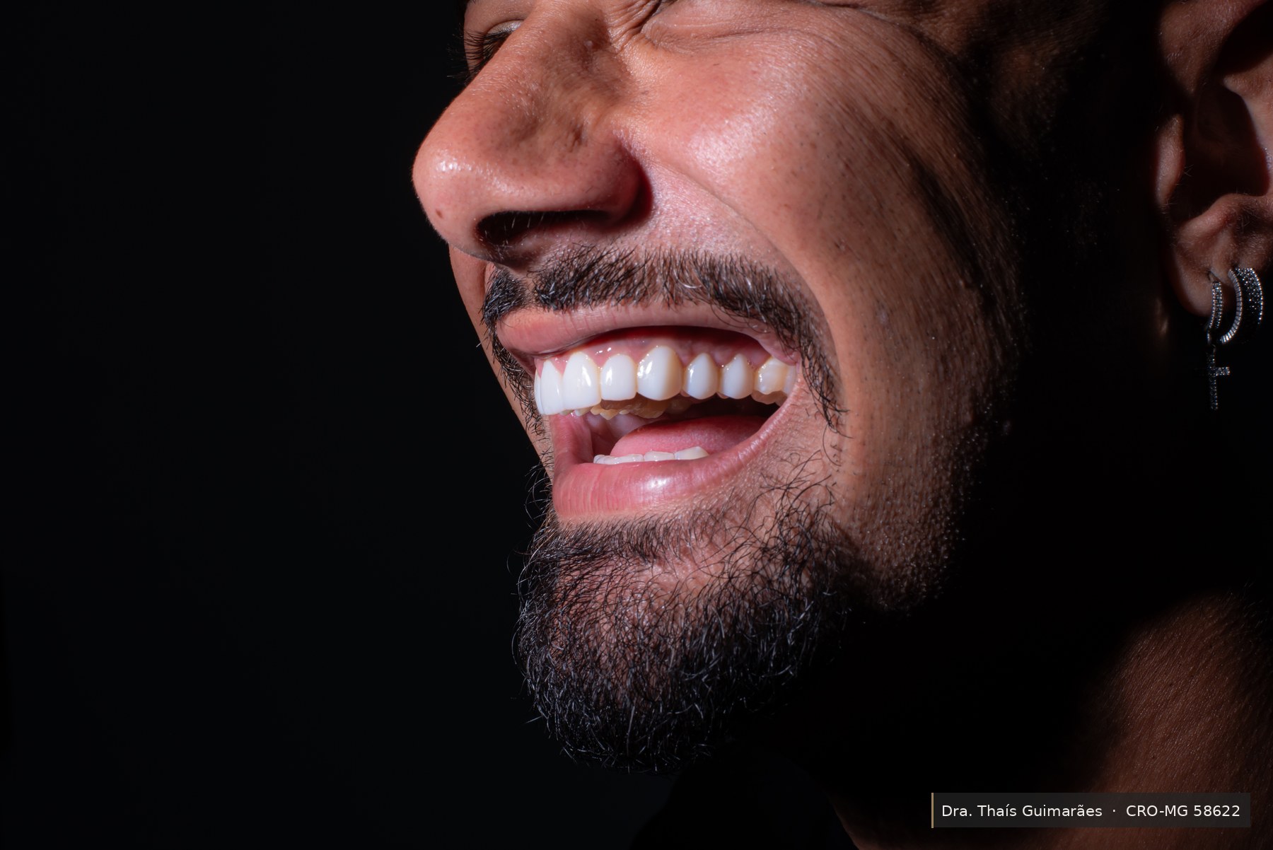 Sorriso finalizado após lentes de contato dental — paciente da Dra. Thaís Guimarães