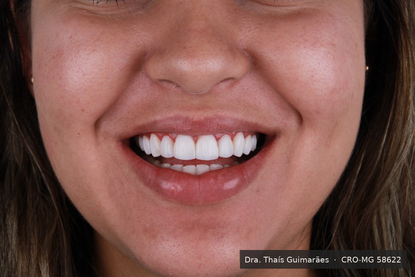 Sorriso finalizado após lentes de contato dental — paciente da Dra. Thaís Guimarães