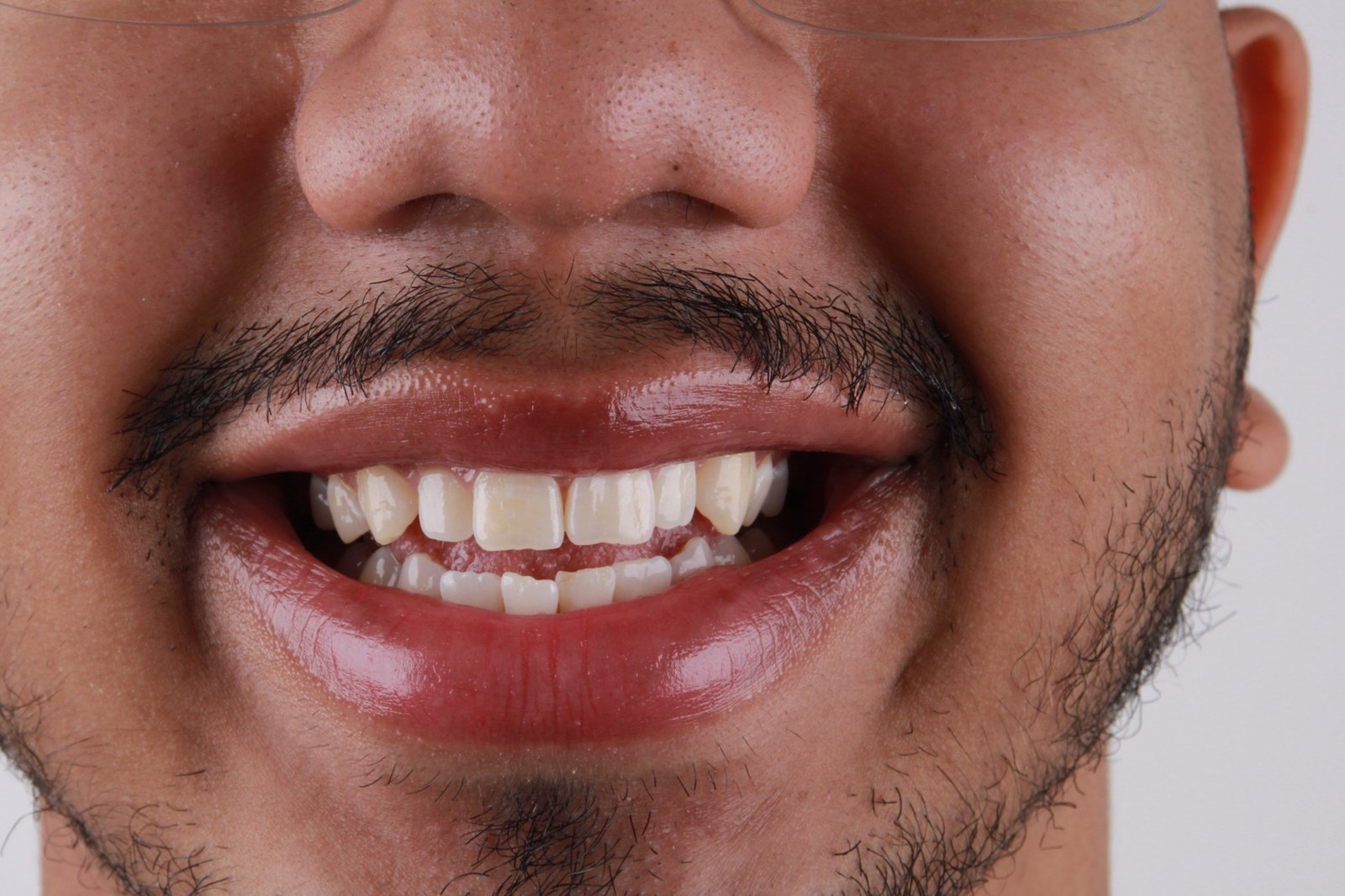 Sorriso antes do tratamento — dentes com espaçamentos e coloração amarelada