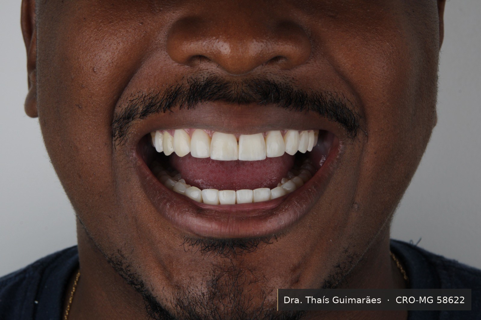 Sorriso finalizado após lentes de contato dental — paciente da Dra. Thaís Guimarães